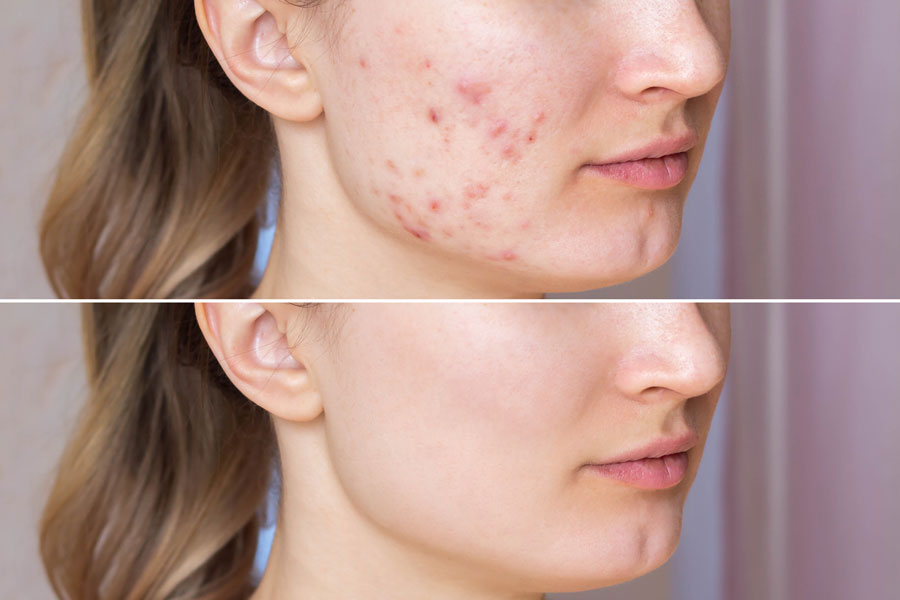 Acne