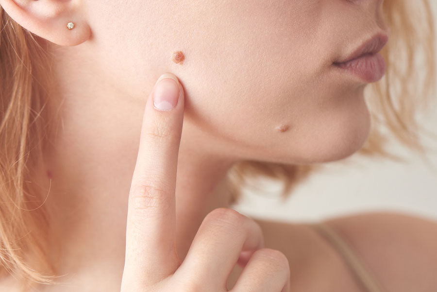 Warts Removal