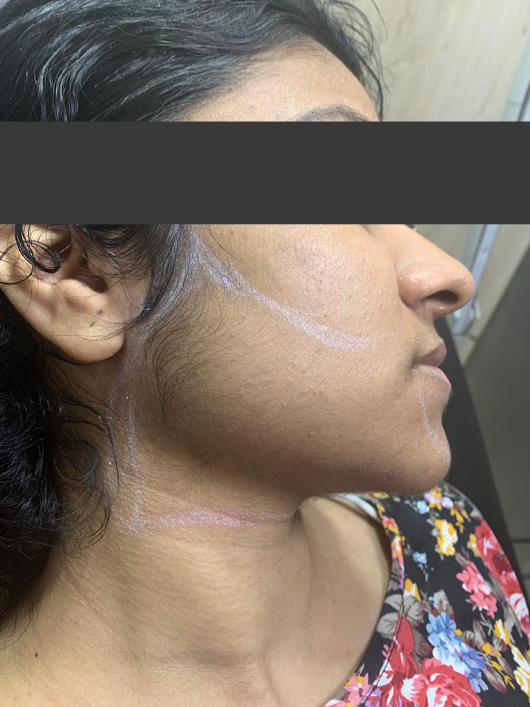 Laser Hair Reduction