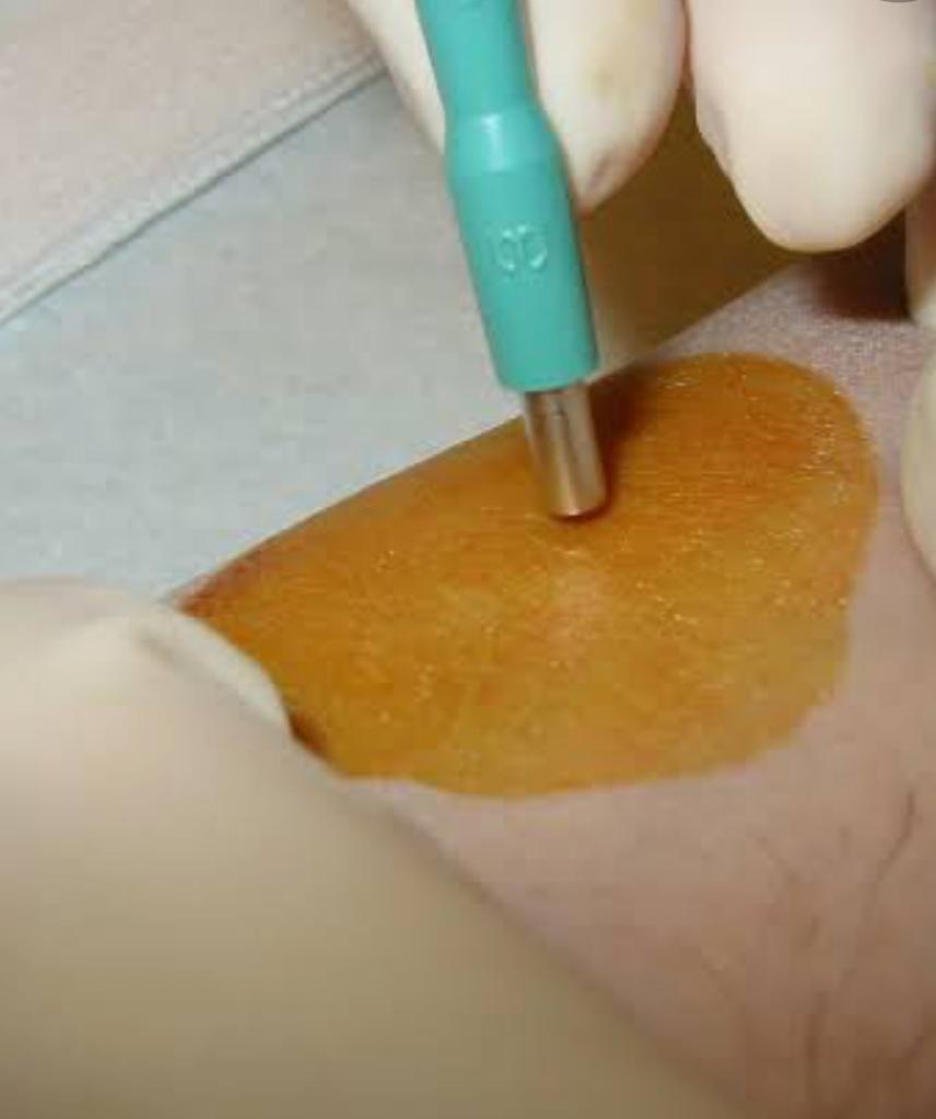 Skin Biopsy