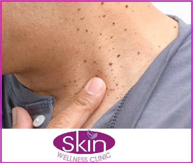 skin tags